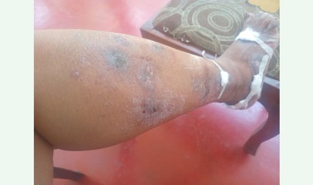 Cover Help to cure  Tenea  Disease