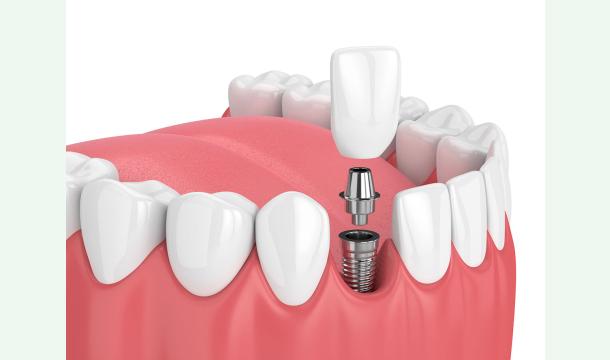 Cover Aidez-moi à retrouver le sourire – soins dentaires urgents