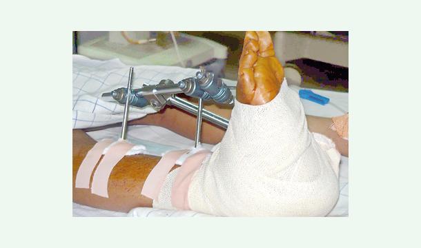 Cover My grandmother's leg surgery.