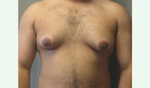 Cover Help Me Treat gynecomastia and Rebuild my confidence 