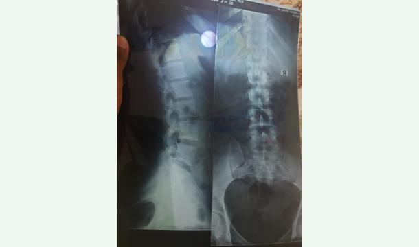 Cover I have a spinal injury, please help me get medicine.