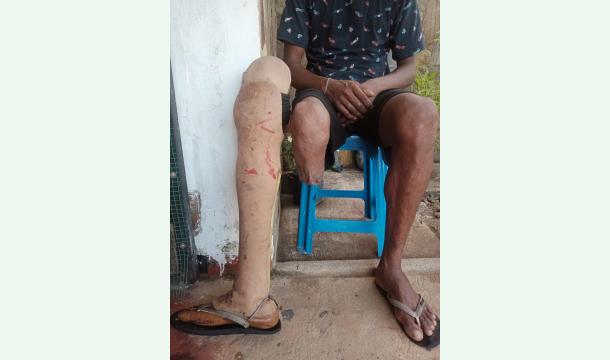 Cover My right leg was amputated below the knee. I am currently wearing a prosthetic leg. I am seeking assistance to repair it.