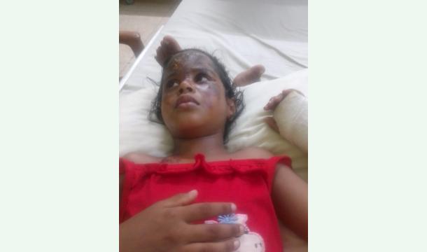 Cover My daughter's face is burned.