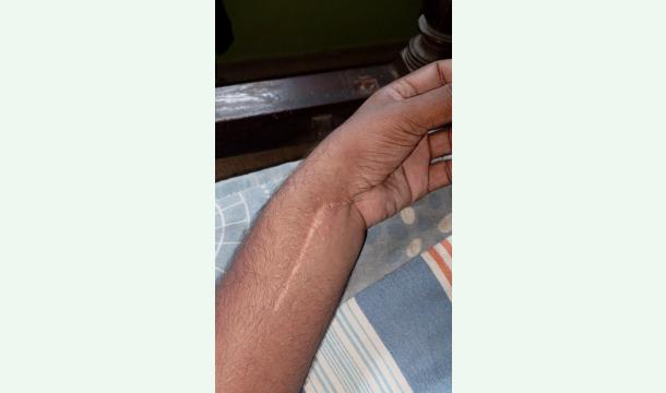 Cover Emergency Hand Surgery – Plate Removal