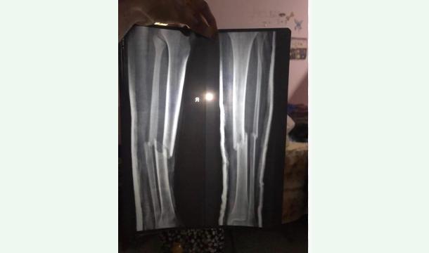 Cover Funding for Broken Leg Bone Surgery 