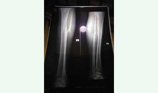Cover To have surgery on my broken leg