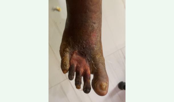 Cover Help me get a prosthetic leg for my father